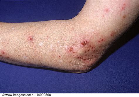 Artifactual Dermatitis Artifactual Dermatitis Artefactual Dermatitis