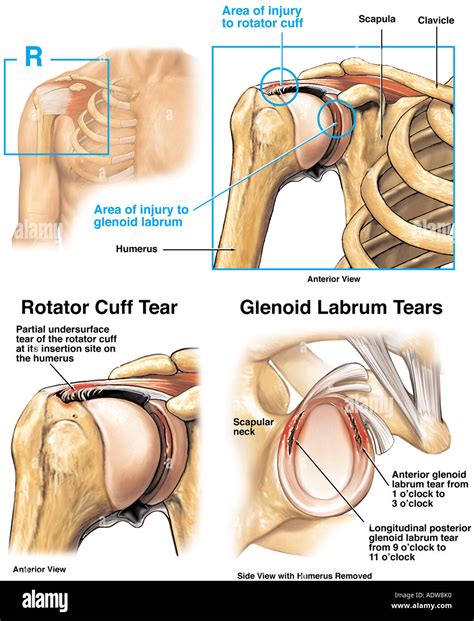 Lesión del hombro roto labrum glenoideo y desgarros del tendón del