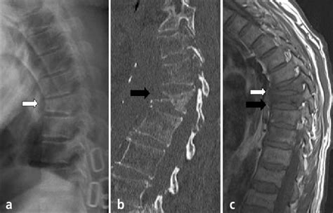 X-ray images of vertebral compression fracture: a) x-ray images of ...