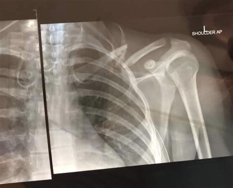 Broken Clavicle : r/Radiology