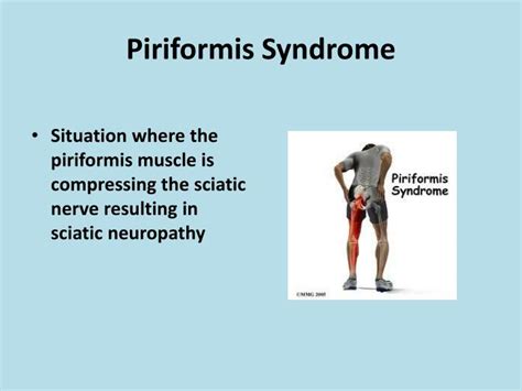 Ppt Piriformis Syndrome Powerpoint Presentation Id2369133