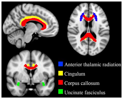 Targeted White Matter Tracts Binary Template Masks From The