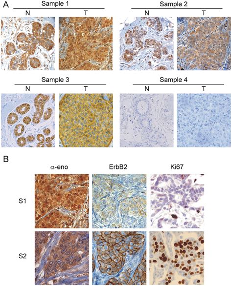 IDC immunohistochemical staining for α enolase and nuclear MBP 1