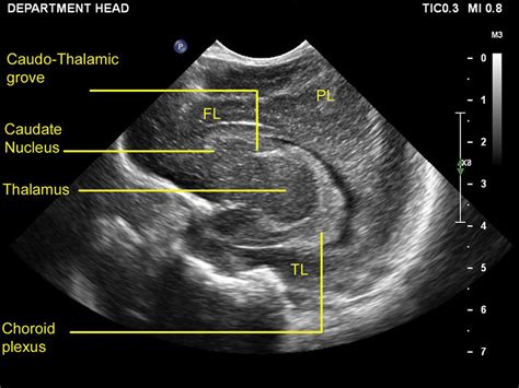 Practical Guide To Neonatal Cranial Ultrasound Crus Basics