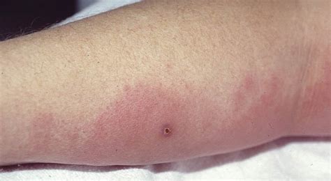 Erysipelas Vs Cellulitis Vs Impetigo