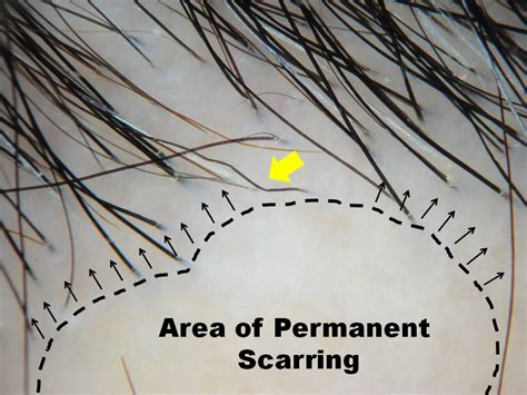 Cicatricial Scarring Alopecia And The Trichologic Emergency — Donovan Hair Clinic