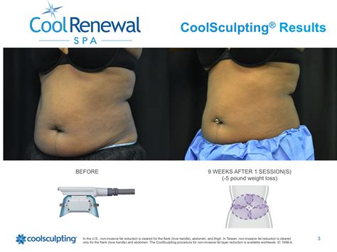 Before And After Cool Renewal Med Spa