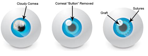 Myths About The Corneal Transplant