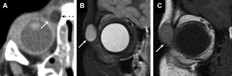 Extraocular Orbital And Peri Orbital Masses Neuroimaging Clinics