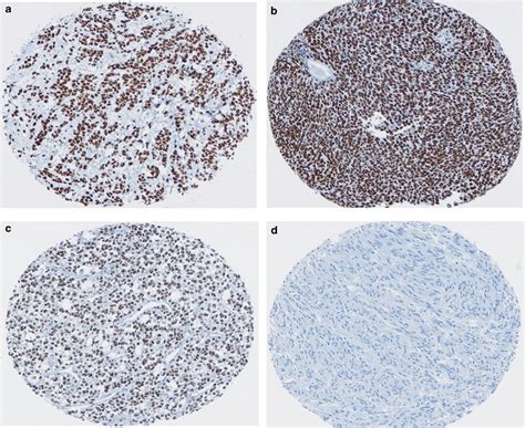 Histone Deacetylase 1 And 2 In Mesenchymal Tumors Modern Pathology