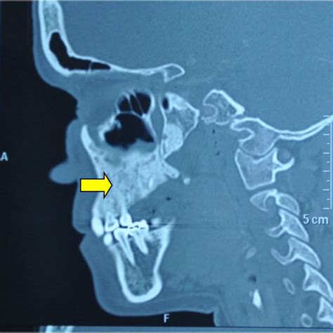 Pdf Fibrous Dysplasia Of The Maxilla A Case Report