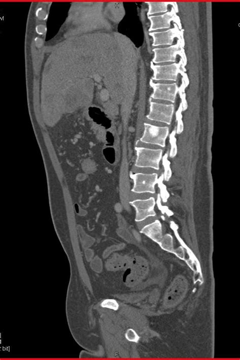 Prostate Cancer Metastasis Prognosis / Widespread Blastic Bone ...