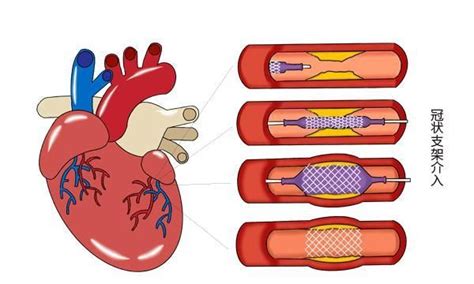 听人说装了心脏支架会缩短寿命是否可信医生的回答很中肯支架心脏患者新浪新闻