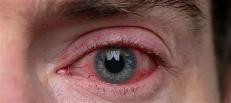 Red Eye Causes Symptoms