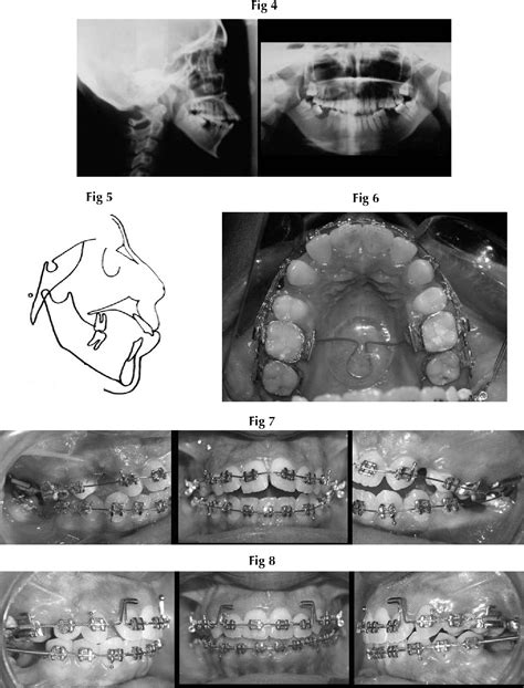 Figure 1 From Non Surgical Treatment Of Mutilated Severe Skeletal Class Ii Malocclusion With