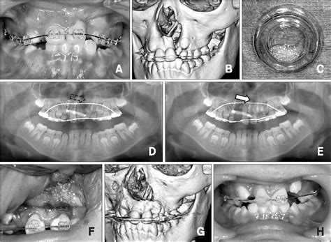 Pdf Alveolar Cleft Reconstruction Using Chin Bone And Autogenous