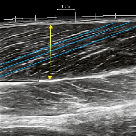 Example Of Extended Fieldofview Ultrasound Image Of Long Head Biceps