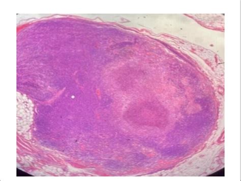 FIGURE E Section Examined Reveals Lymph Node Showing Areas Of Necrosis