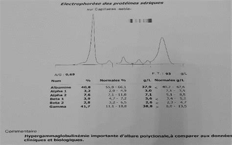 Polyclonal hypergammaglobulinemia electrophoretic. | Download ...