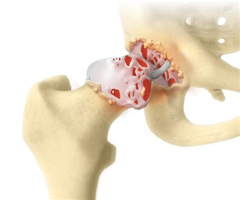 Hip Pain Relief - Surgical Treatment Options