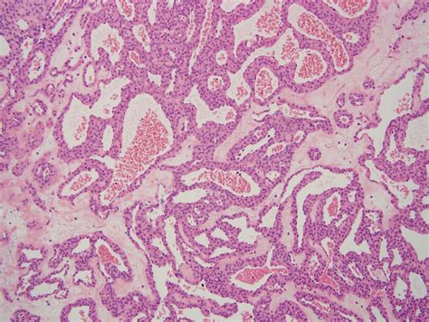 Pathology Outlines Glomus Tumor