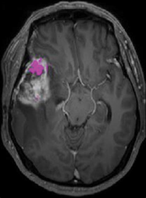 Differentiation Of Recurrent Glioblastoma From Delayed Radiation