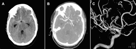 Subarachnoid Space Hemorrhage Ultrasound