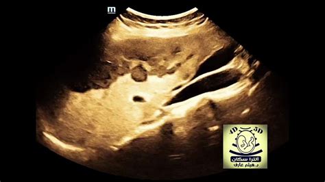 Hcc Ultrasound By Dr Haissam Aref Dms Msc Md Ultrasound Youtube