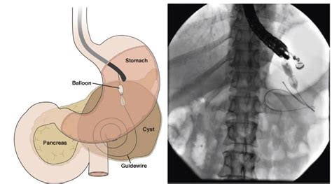 Navigating Pancreatic Pseudocysts The Role Of Endoscopic Ultrasound