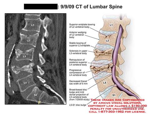 Amicus Illustration Of Amicus Radiology Ct Lumbar Spine Endplate