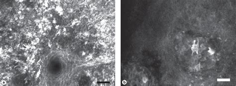 Figure From The Diagnostic Accuracy Of In Vivo Confocal Scanning