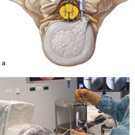 Full Endoscopic Anterior Excision Of Thoracic Disc Herniations