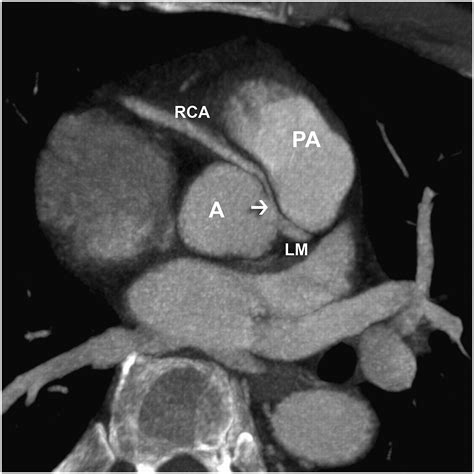 Cardiac Ct Indications And Limitations Journal Of Nuclear Medicine