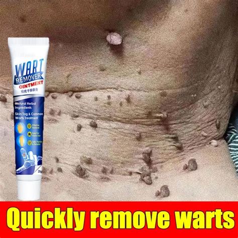 Warts Remover Original Cream Wart Removal Ointment Wart Treatment