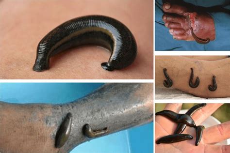 Leech Therapy In Ayurveda Maurya In 2024 Ayurveda Leech Therapy