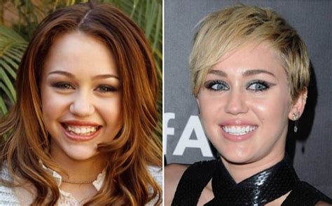 Miley Cyrus Veneers