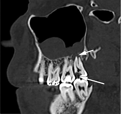 Odontogenic sinusitis. Oblique sagittal CT image shows mucosal... | Download Scientific Diagram