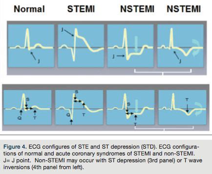 Is This A True STEMI ECG Typical And Atypical Findings