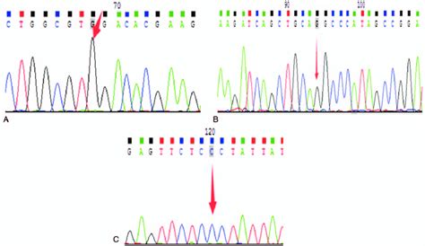 Sanger Sequencing Results Verifying The Homozygous Variant A Patient