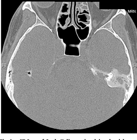 Malignant Otitis Externa Semantic Scholar