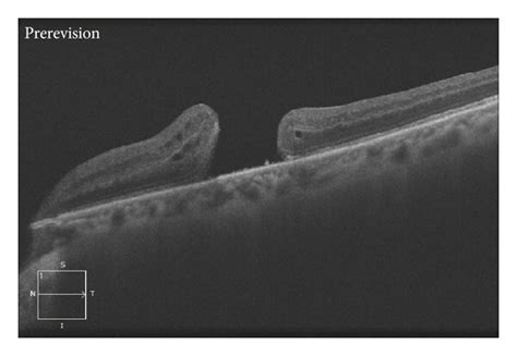 Preoperative And Postoperative Oct Scans A Preoperative Oct Scan Of