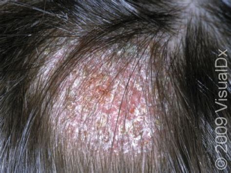 Ringworm On Scalp Behind Ear