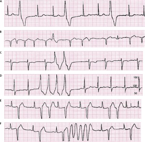 12: ECG Patterns of Ventricular Arrhythmias | Thoracic Key