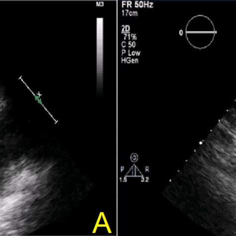 A Transthoracic Echocardiography Image Showing Normal Left Ventricle Download Scientific