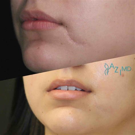 Scar Revision La Jolla Dermatology