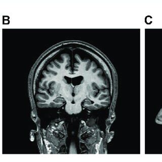 A B Brain Magnetic Resonance Imaging MRI Showing Bilateral