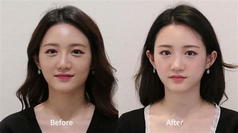 Rhinoplasty Korea Before And After Rhinoplasty Surgeon Rhinoplasty