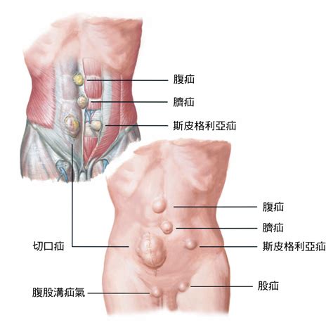 疝氣種類 台灣疝氣手術中心