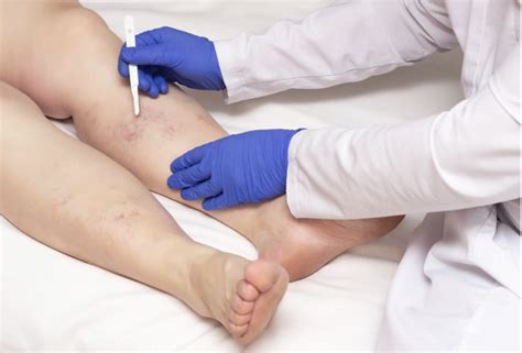 Ambulatory Phlebectomy For Varicose Veins Physicians Vein Clinics