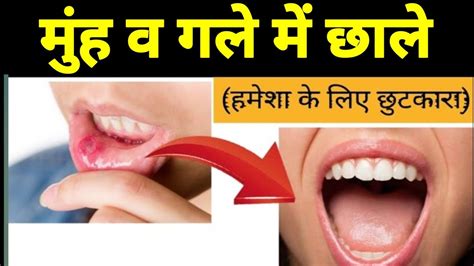 Mouth Ulcer यानी मुंह में छाले क्यों हो जाते हैं कैसे ठीक करें जानें Doctors से Ayurvedic